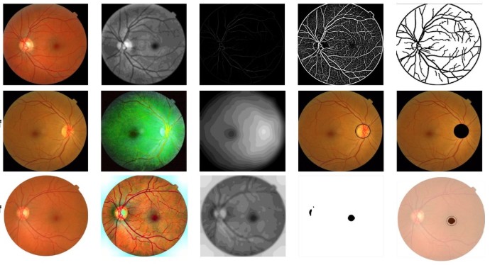 Diabetic retinopathy retinal image heatmap